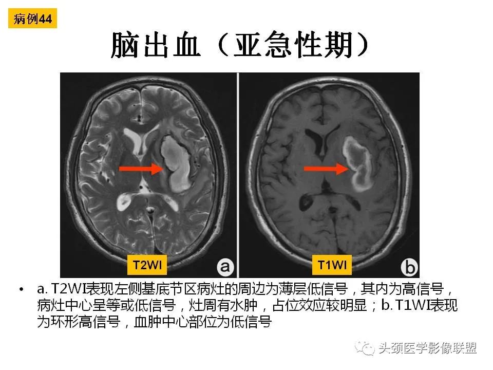 影像PPT - 【PPT】颅脑解剖及血管性病变的MRI诊断-131