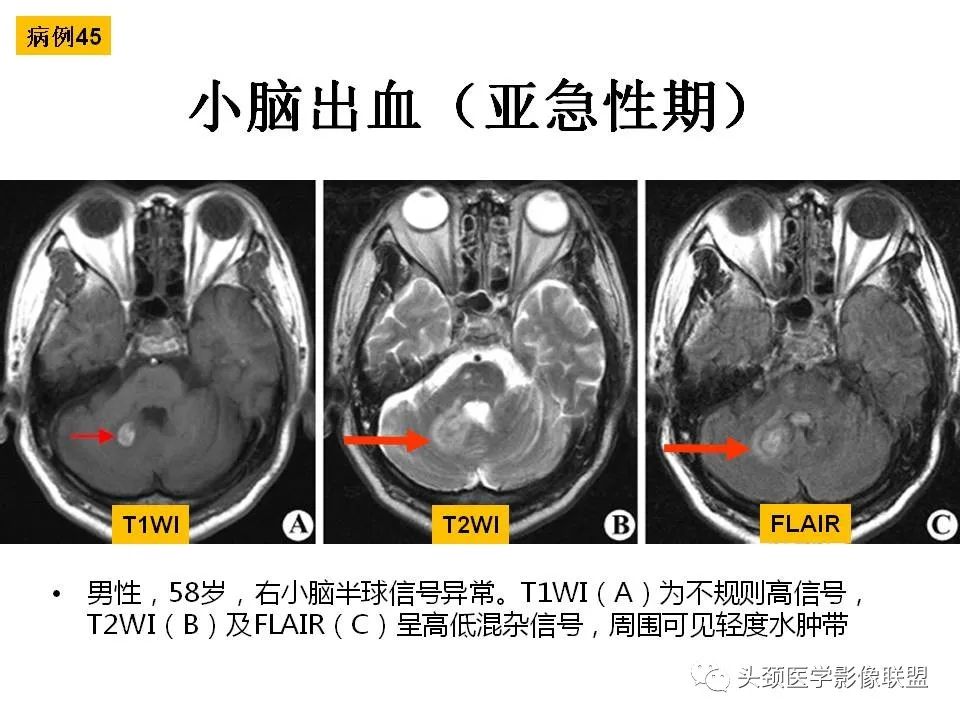 影像PPT - 【PPT】颅脑解剖及血管性病变的MRI诊断-132