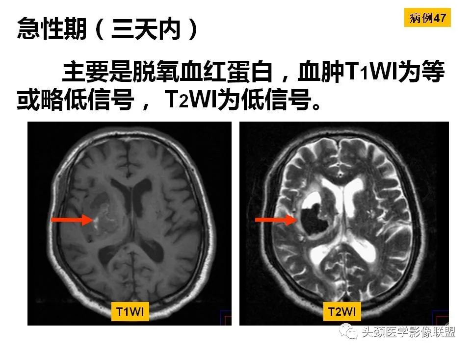 影像PPT - 【PPT】颅脑解剖及血管性病变的MRI诊断-134