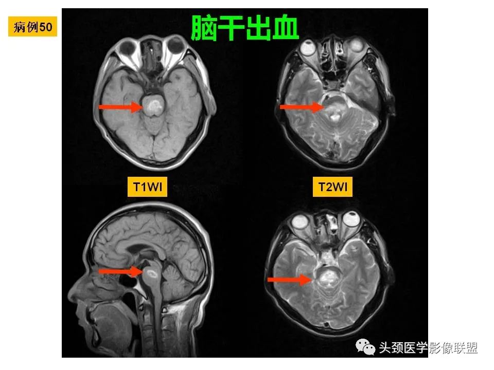 影像PPT - 【PPT】颅脑解剖及血管性病变的MRI诊断-137
