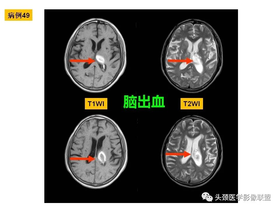 影像PPT - 【PPT】颅脑解剖及血管性病变的MRI诊断-136
