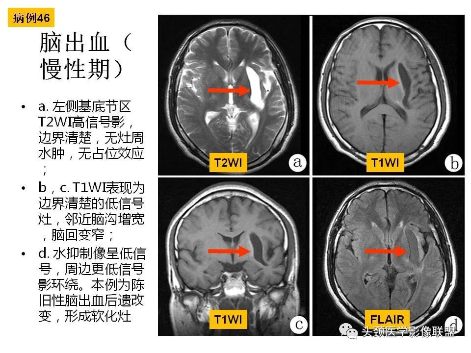 影像PPT - 【PPT】颅脑解剖及血管性病变的MRI诊断-133