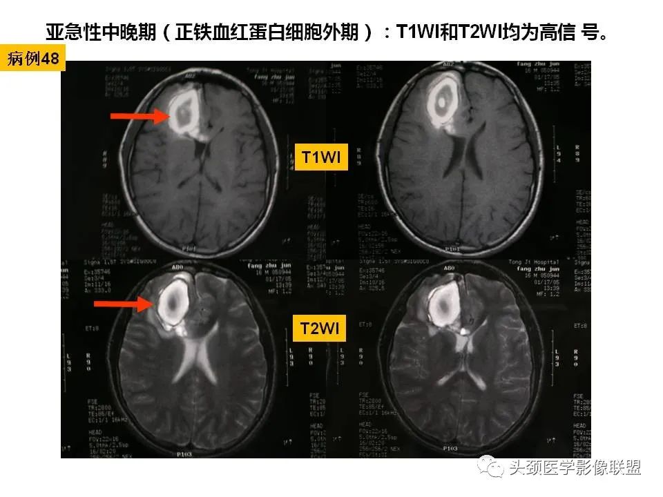 影像PPT - 【PPT】颅脑解剖及血管性病变的MRI诊断-135