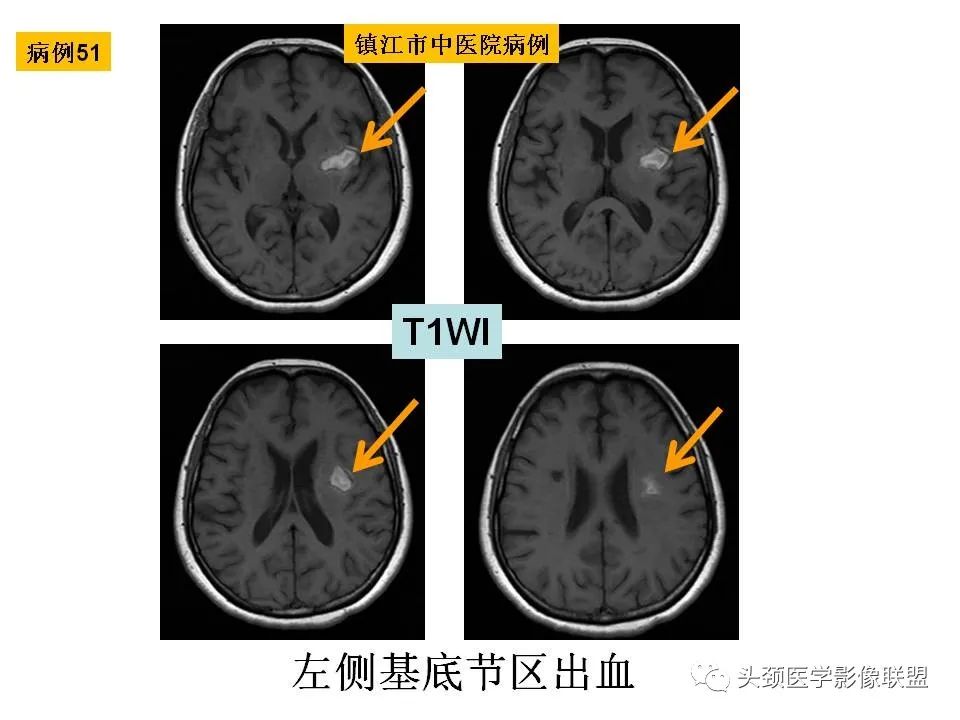 影像PPT - 【PPT】颅脑解剖及血管性病变的MRI诊断-138