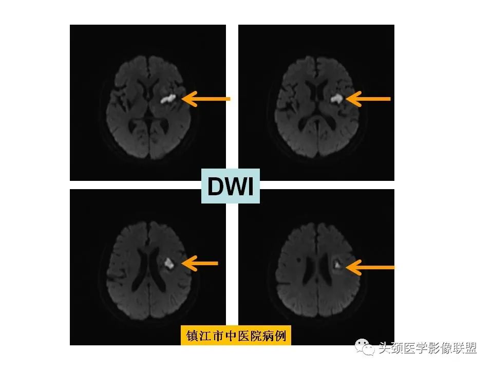 影像PPT - 【PPT】颅脑解剖及血管性病变的MRI诊断-141