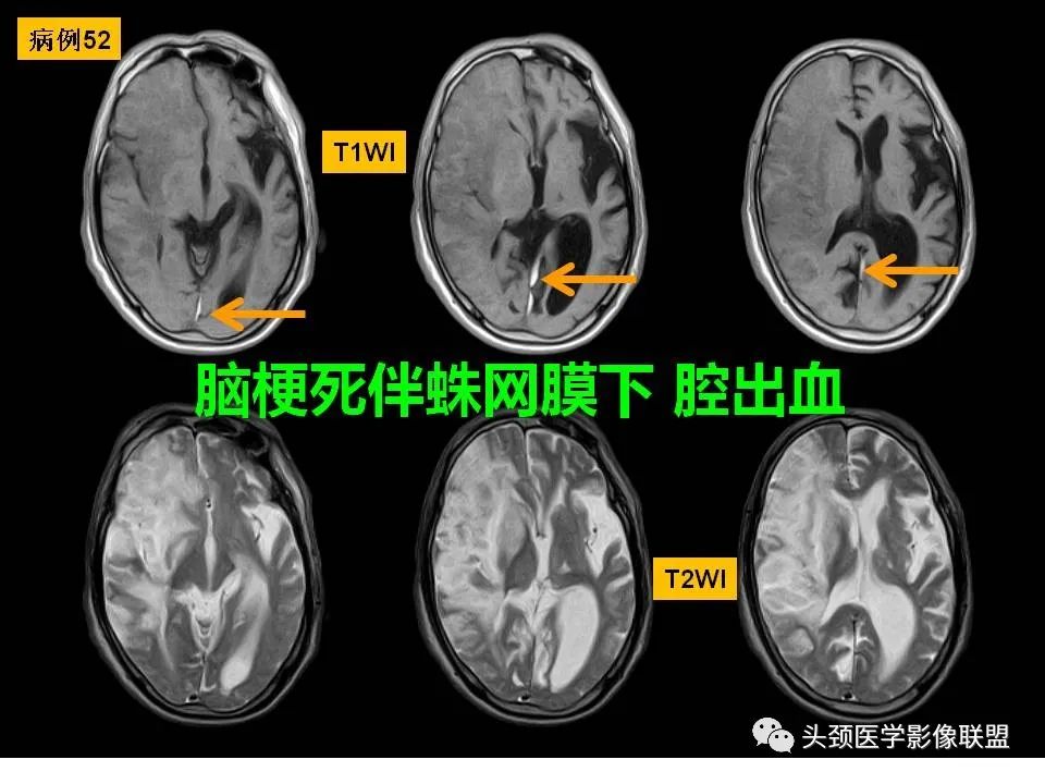 影像PPT - 【PPT】颅脑解剖及血管性病变的MRI诊断-145