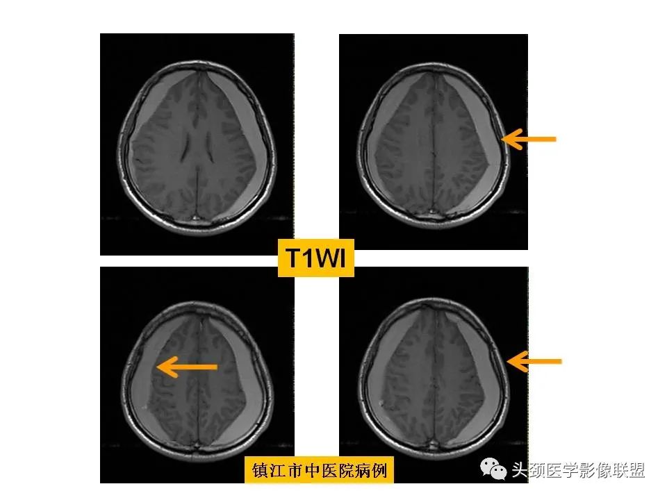 影像PPT - 【PPT】颅脑解剖及血管性病变的MRI诊断-148