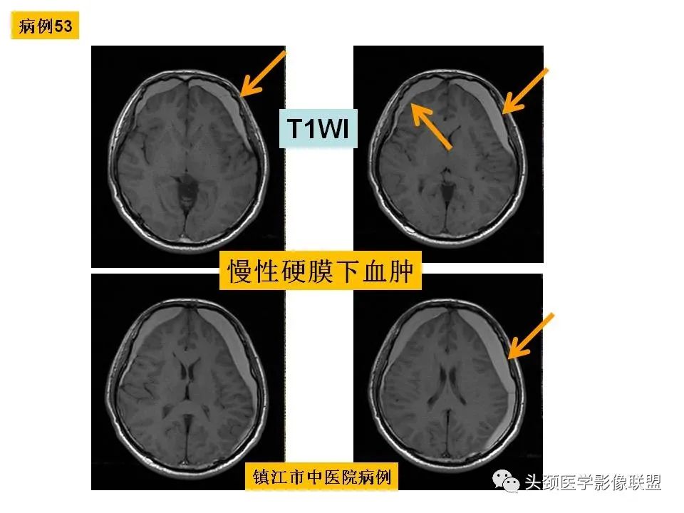 影像PPT - 【PPT】颅脑解剖及血管性病变的MRI诊断-147