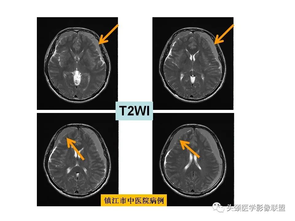 影像PPT - 【PPT】颅脑解剖及血管性病变的MRI诊断-149