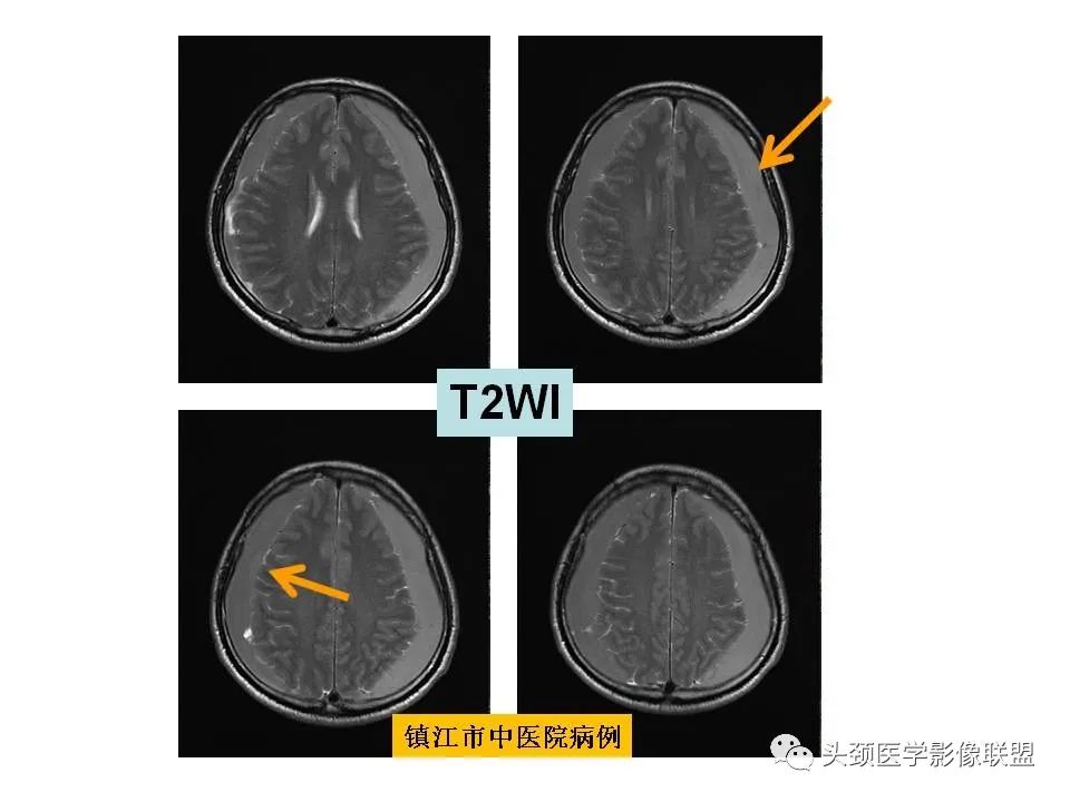 影像PPT - 【PPT】颅脑解剖及血管性病变的MRI诊断-150
