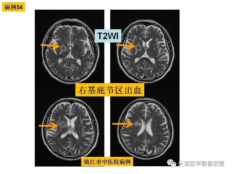 影像PPT - 【PPT】颅脑解剖及血管性病变的MRI诊断-153