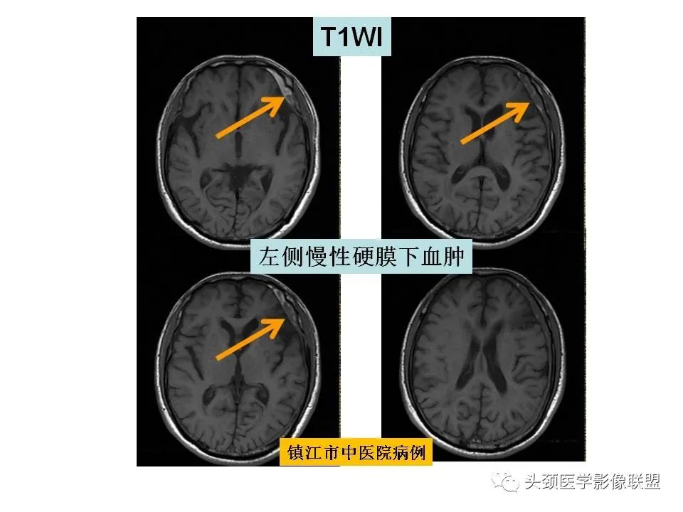 影像PPT - 【PPT】颅脑解剖及血管性病变的MRI诊断-158