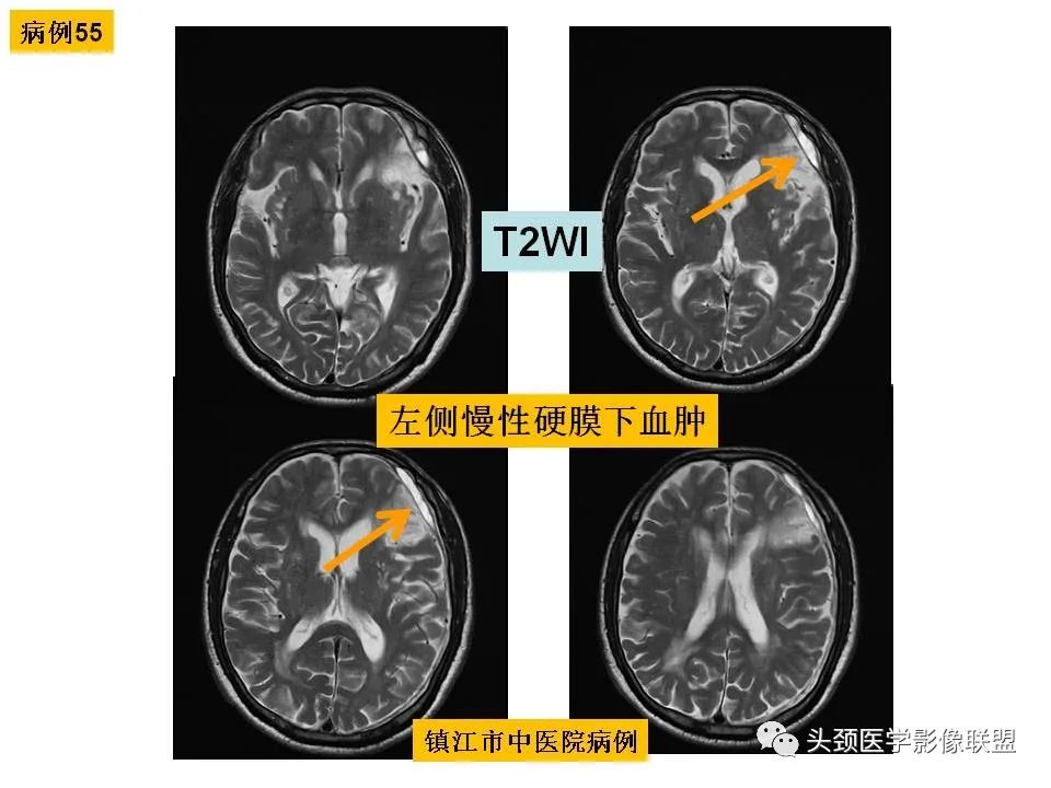 影像PPT - 【PPT】颅脑解剖及血管性病变的MRI诊断-157