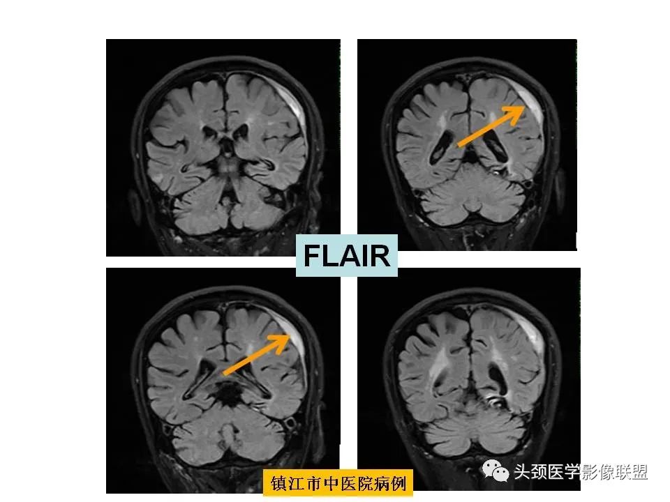 影像PPT - 【PPT】颅脑解剖及血管性病变的MRI诊断-159
