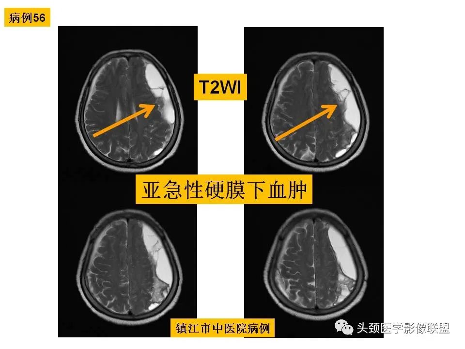 影像PPT - 【PPT】颅脑解剖及血管性病变的MRI诊断-161