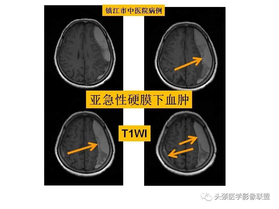 影像PPT - 【PPT】颅脑解剖及血管性病变的MRI诊断-162