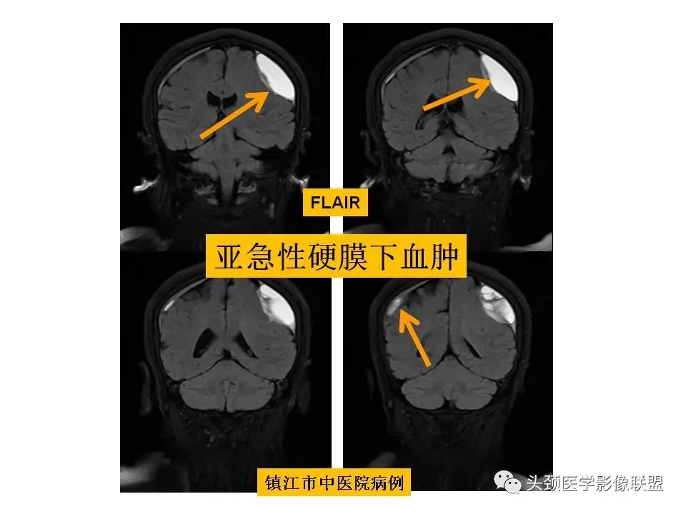 影像PPT - 【PPT】颅脑解剖及血管性病变的MRI诊断-163