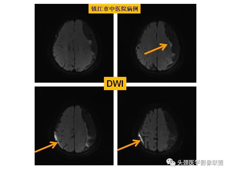 影像PPT - 【PPT】颅脑解剖及血管性病变的MRI诊断-164