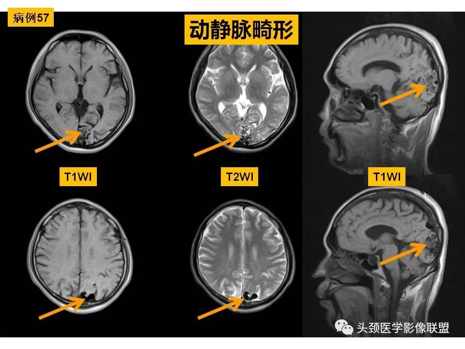 影像PPT - 【PPT】颅脑解剖及血管性病变的MRI诊断-169