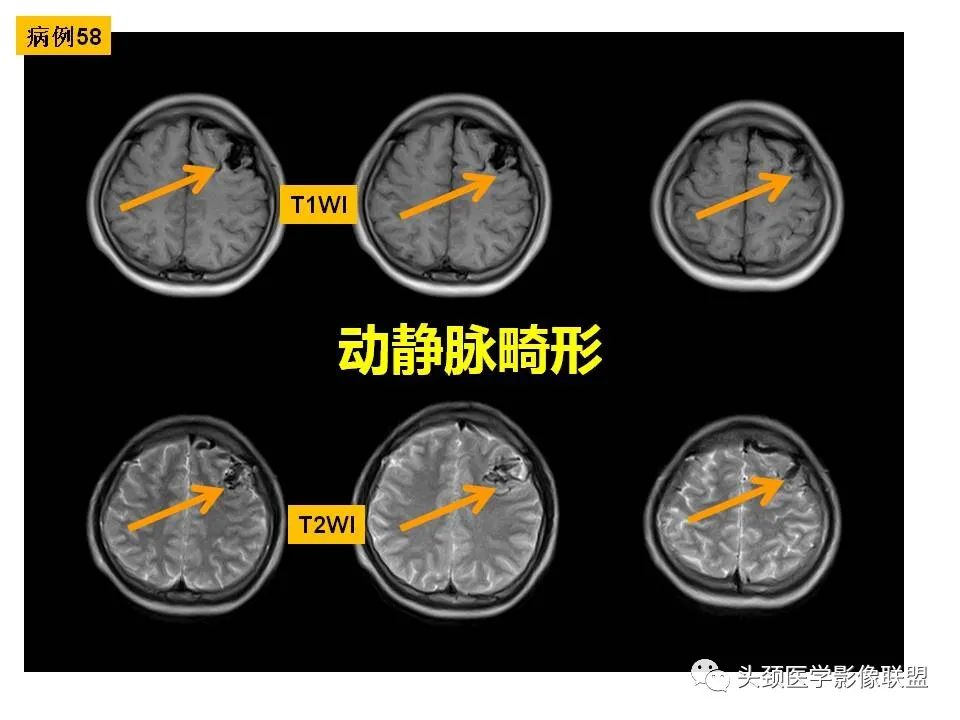 影像PPT - 【PPT】颅脑解剖及血管性病变的MRI诊断-170
