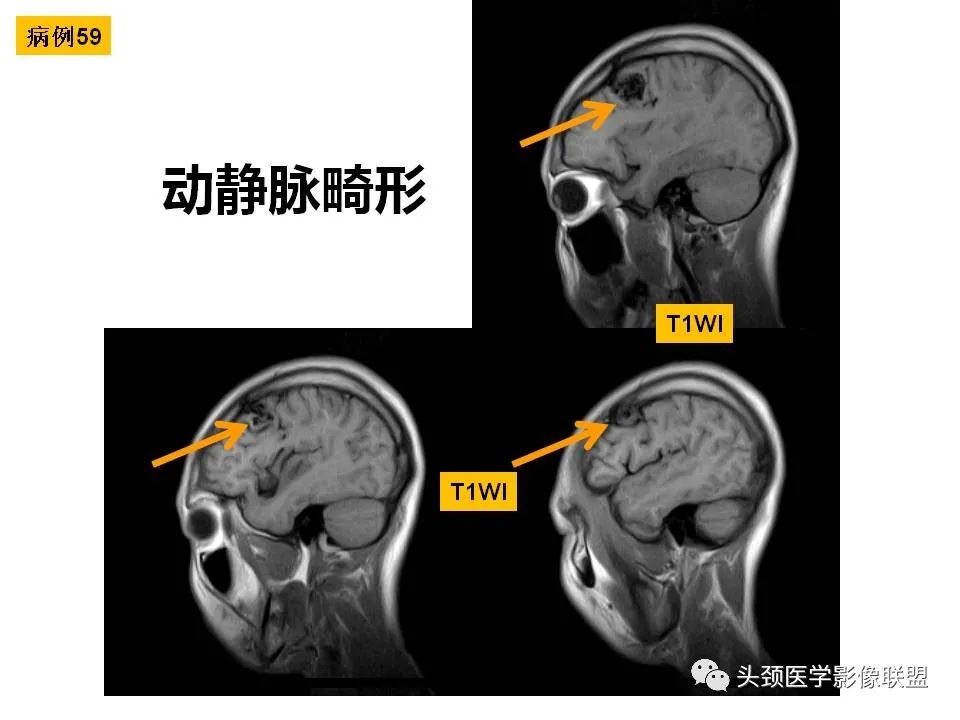 影像PPT - 【PPT】颅脑解剖及血管性病变的MRI诊断-171