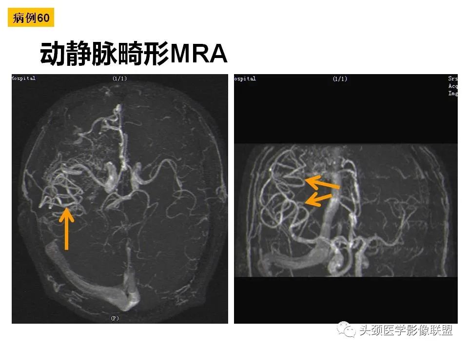 影像PPT - 【PPT】颅脑解剖及血管性病变的MRI诊断-172