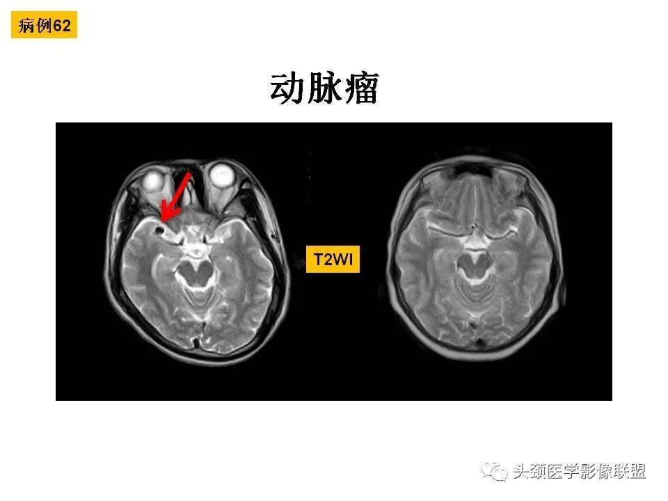 影像PPT - 【PPT】颅脑解剖及血管性病变的MRI诊断-179