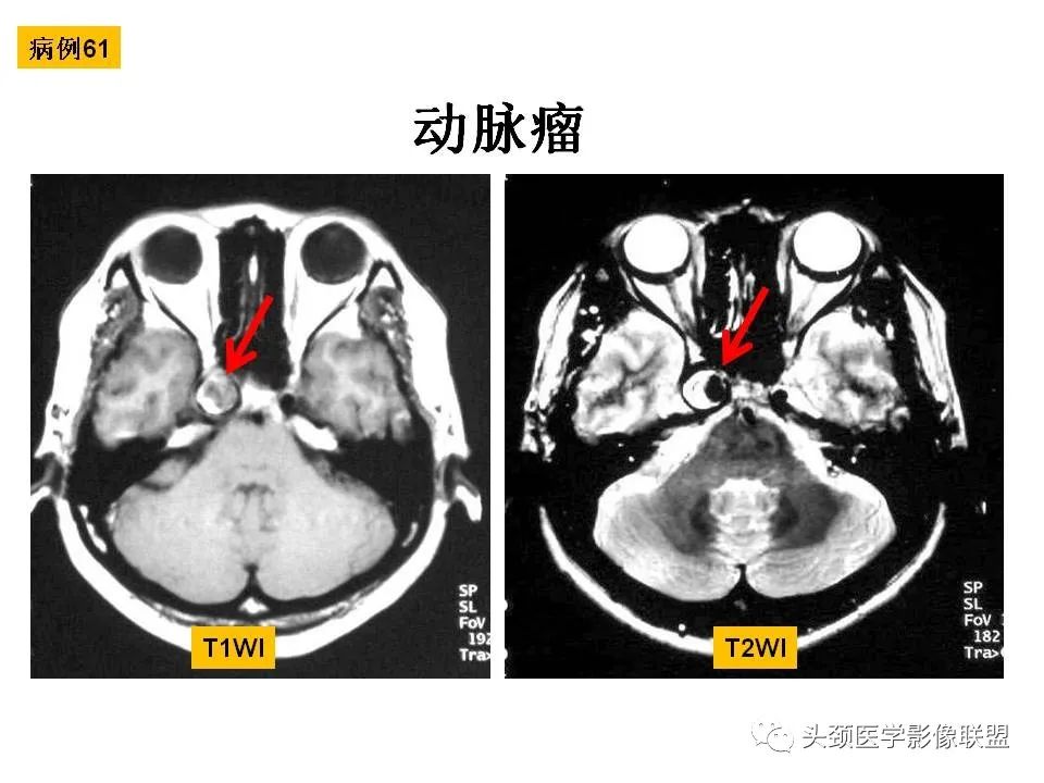 影像PPT - 【PPT】颅脑解剖及血管性病变的MRI诊断-178