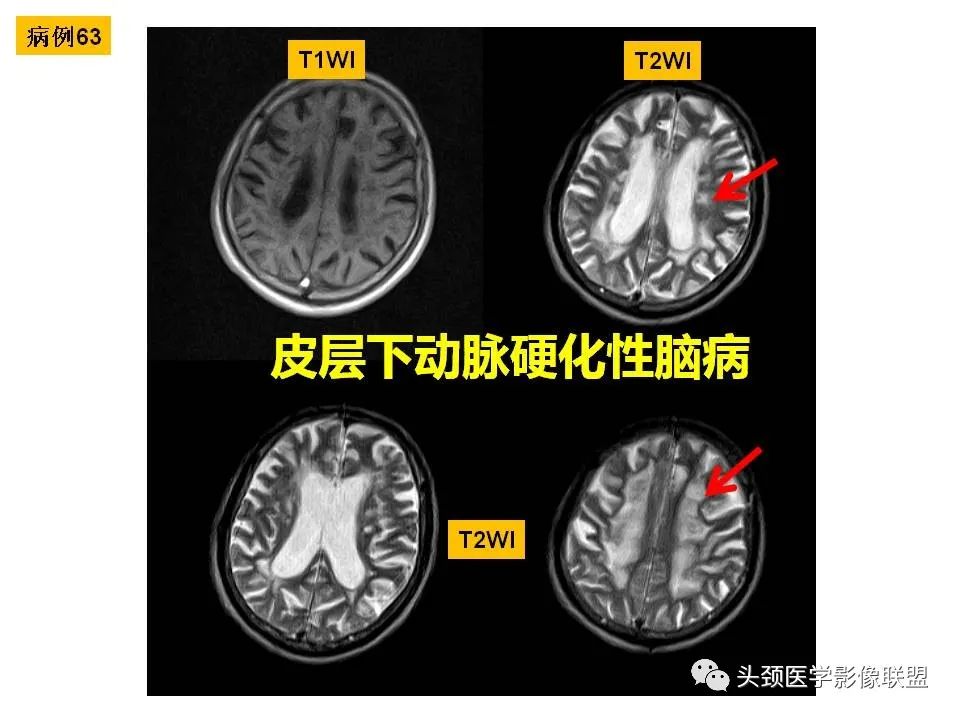 影像PPT - 【PPT】颅脑解剖及血管性病变的MRI诊断-183