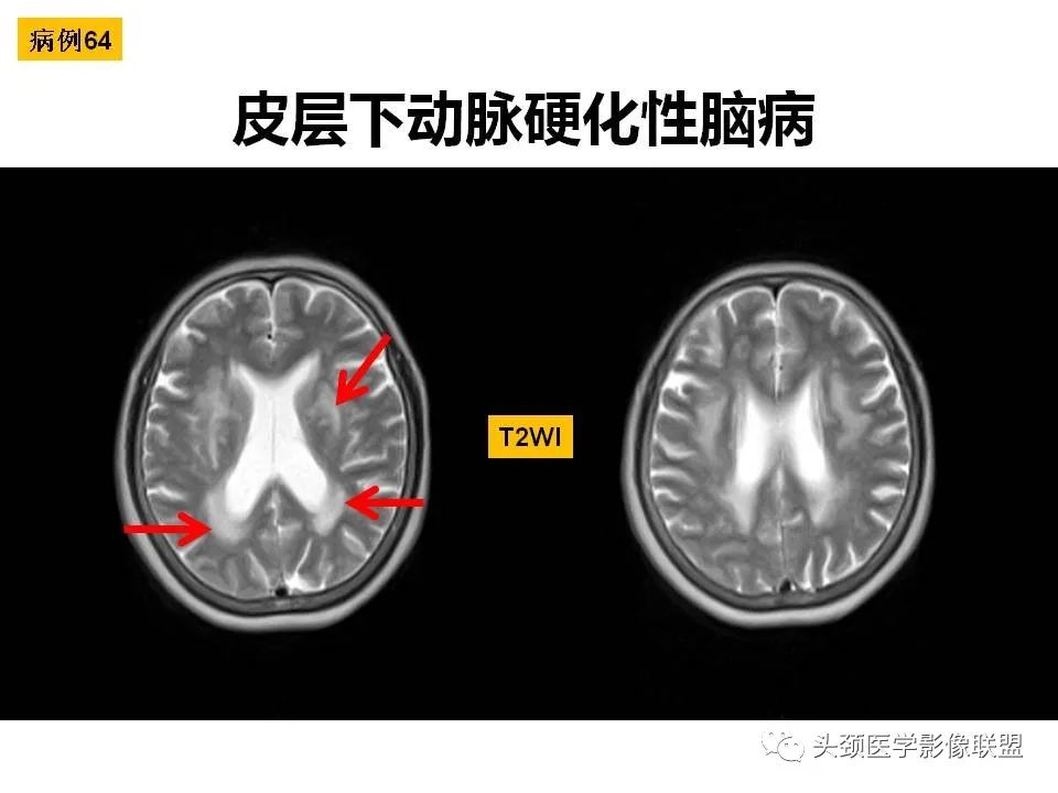 影像PPT - 【PPT】颅脑解剖及血管性病变的MRI诊断-184