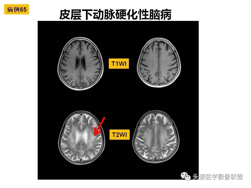 影像PPT - 【PPT】颅脑解剖及血管性病变的MRI诊断-185