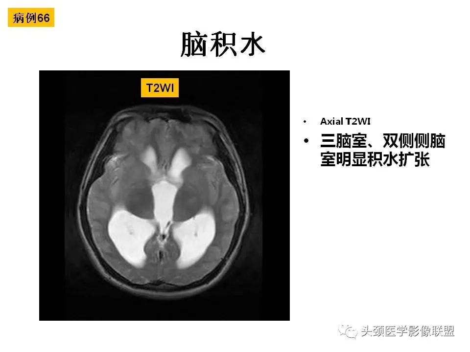影像PPT - 【PPT】颅脑解剖及血管性病变的MRI诊断-188