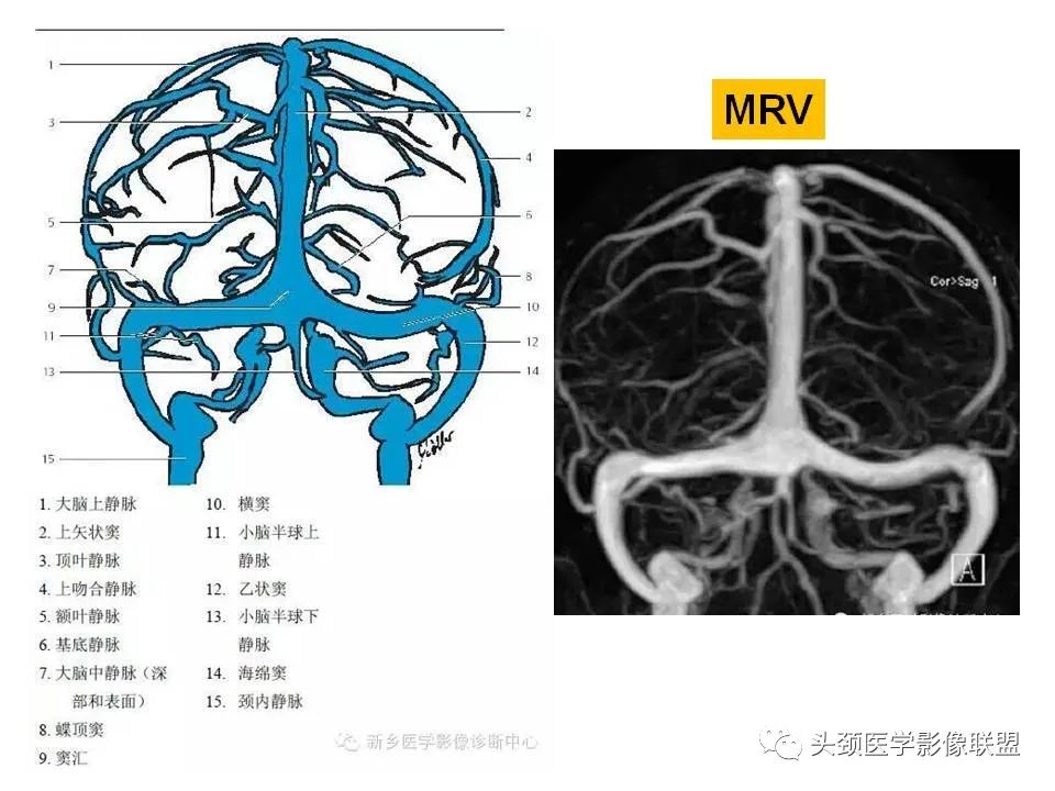影像PPT - 【PPT】颅脑解剖及血管性病变的MRI诊断-198