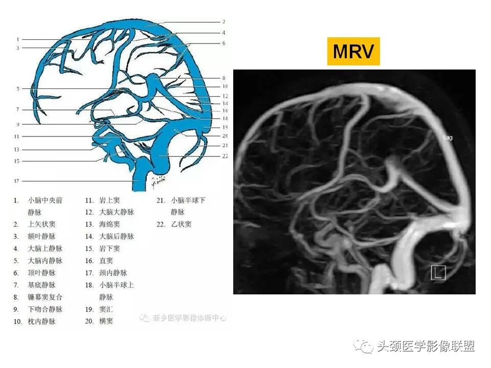 影像PPT - 【PPT】颅脑解剖及血管性病变的MRI诊断-199