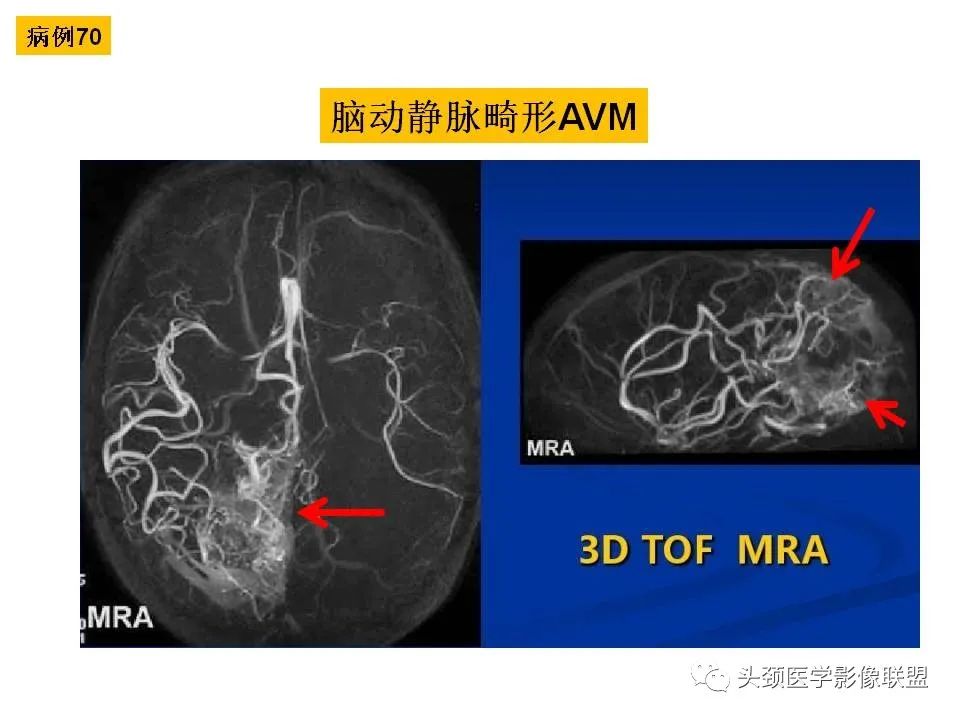 影像PPT - 【PPT】颅脑解剖及血管性病变的MRI诊断-205
