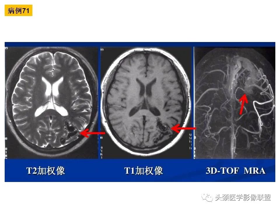 影像PPT - 【PPT】颅脑解剖及血管性病变的MRI诊断-206