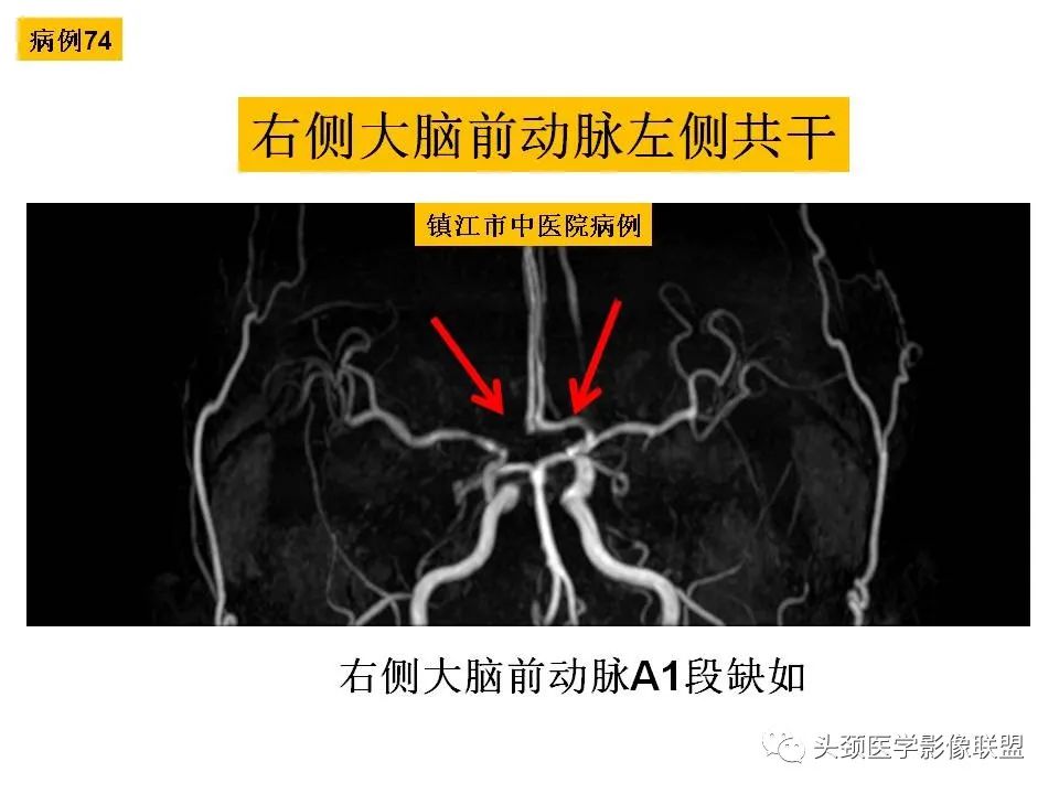 影像PPT - 【PPT】颅脑解剖及血管性病变的MRI诊断-209