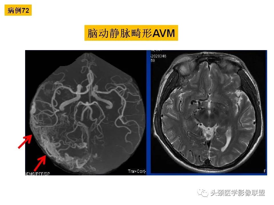 影像PPT - 【PPT】颅脑解剖及血管性病变的MRI诊断-207