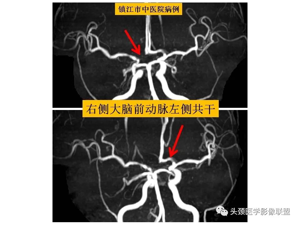 影像PPT - 【PPT】颅脑解剖及血管性病变的MRI诊断-210
