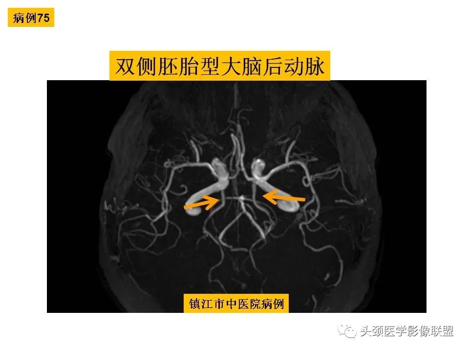 影像PPT - 【PPT】颅脑解剖及血管性病变的MRI诊断-211