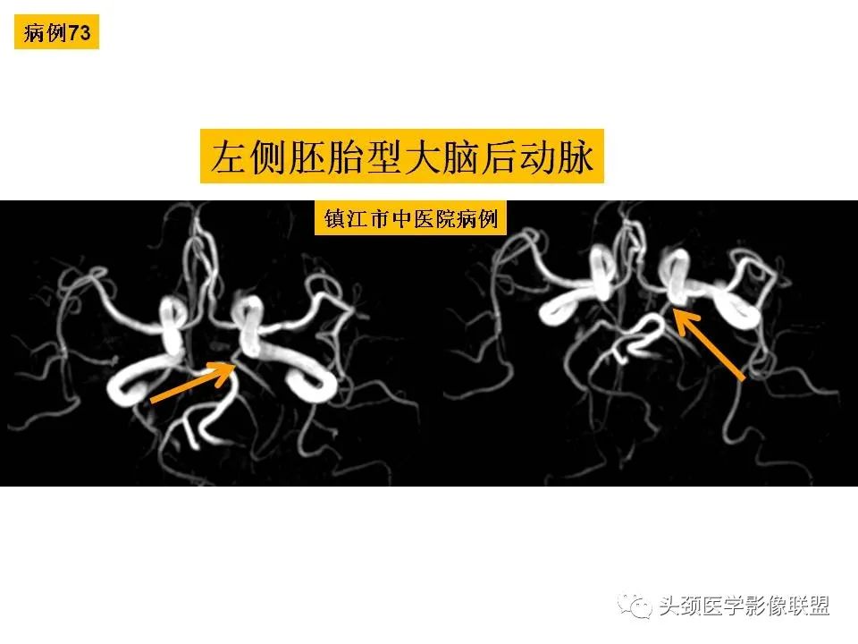 影像PPT - 【PPT】颅脑解剖及血管性病变的MRI诊断-208