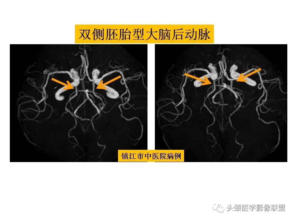 影像PPT - 【PPT】颅脑解剖及血管性病变的MRI诊断-212