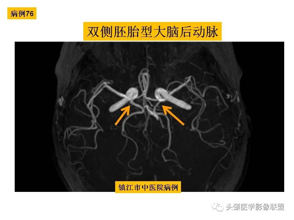影像PPT - 【PPT】颅脑解剖及血管性病变的MRI诊断-213