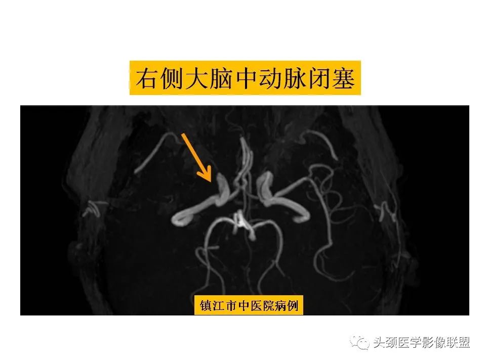 影像PPT - 【PPT】颅脑解剖及血管性病变的MRI诊断-215