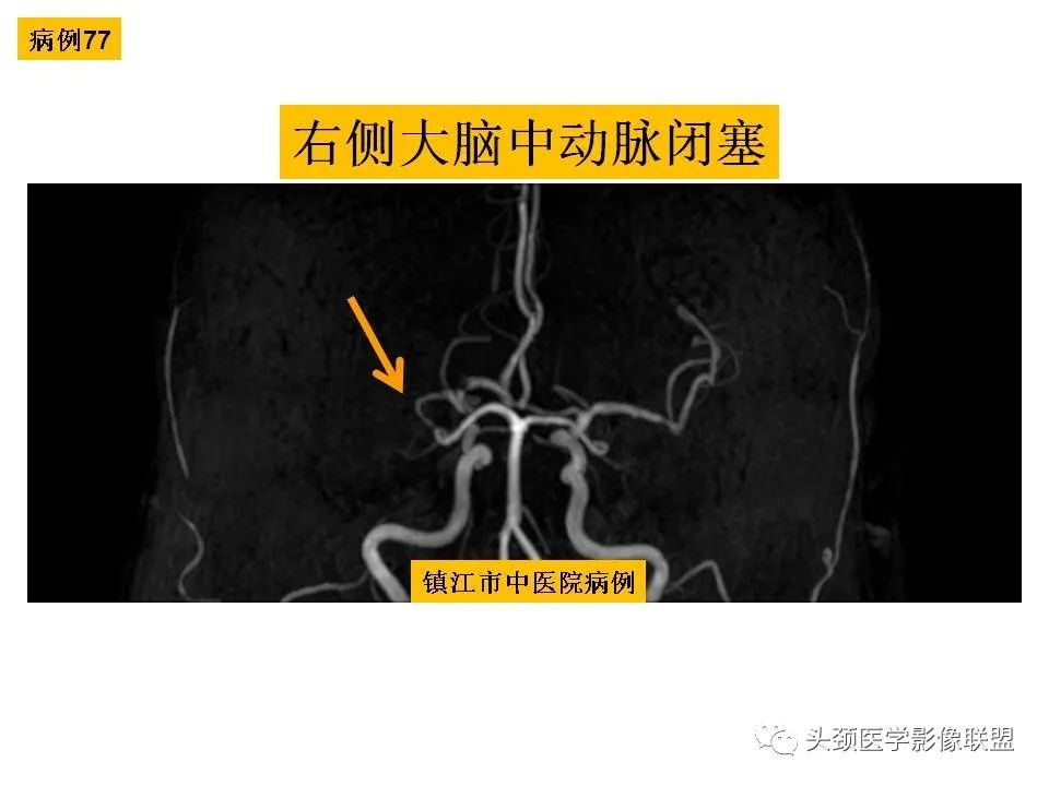 影像PPT - 【PPT】颅脑解剖及血管性病变的MRI诊断-214