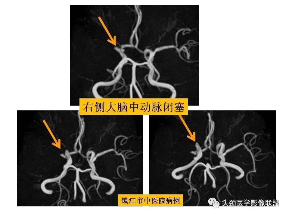 影像PPT - 【PPT】颅脑解剖及血管性病变的MRI诊断-216