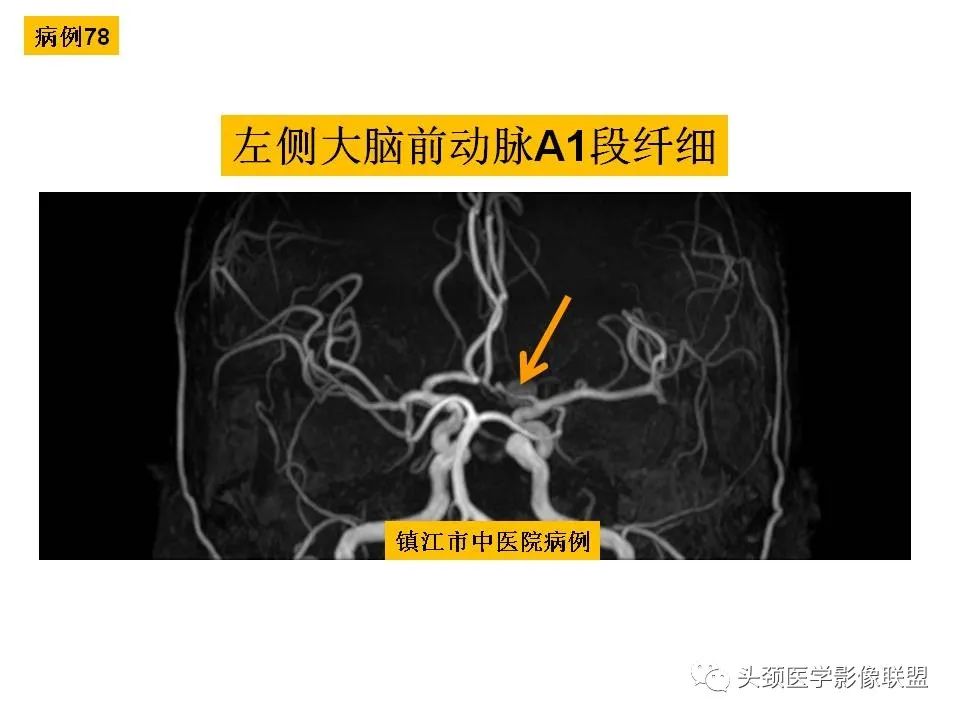 影像PPT - 【PPT】颅脑解剖及血管性病变的MRI诊断-217