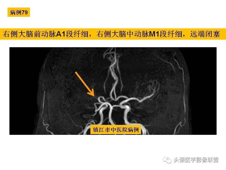 影像PPT - 【PPT】颅脑解剖及血管性病变的MRI诊断-218
