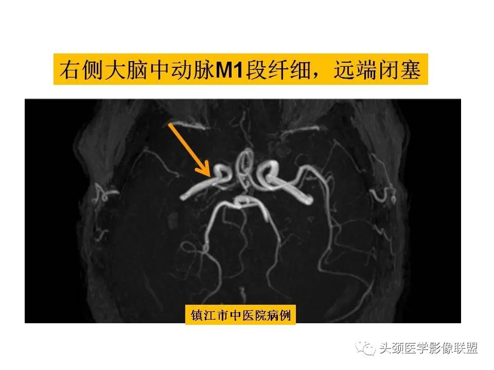 影像PPT - 【PPT】颅脑解剖及血管性病变的MRI诊断-219