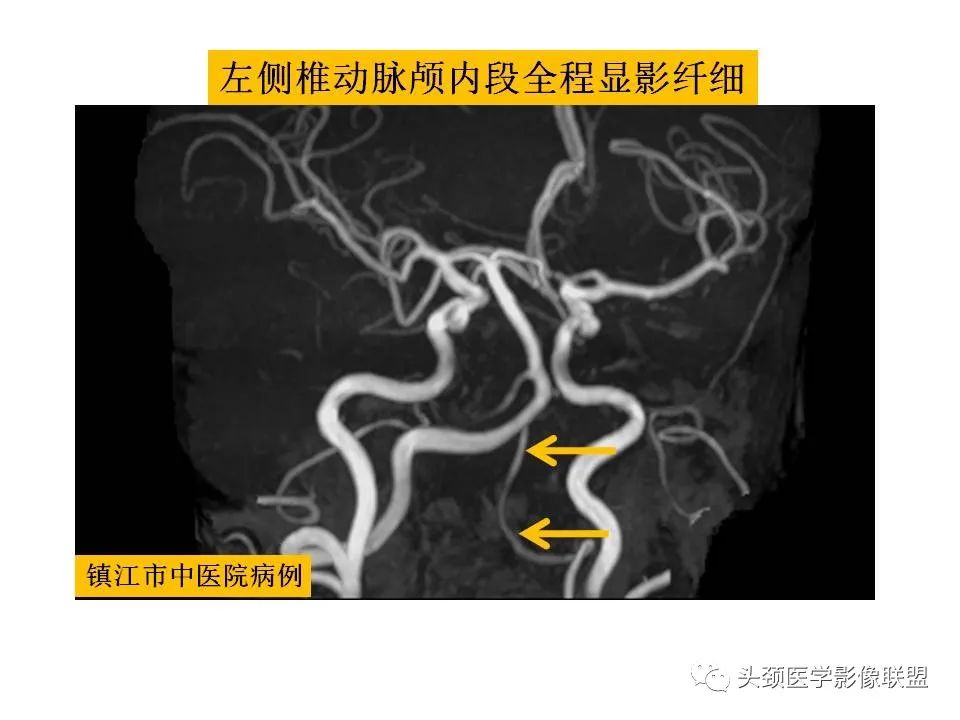影像PPT - 【PPT】颅脑解剖及血管性病变的MRI诊断-222